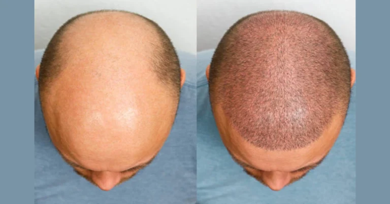 Hair Transplant