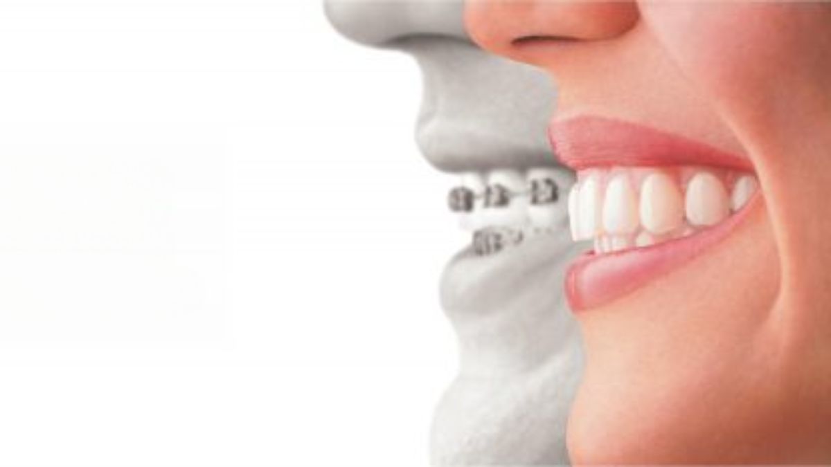 Dental Implants in West Hollywood